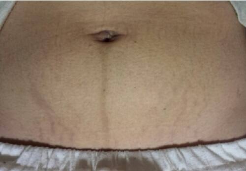 お腹の肉割れ(妊娠線)の画像|ケース1