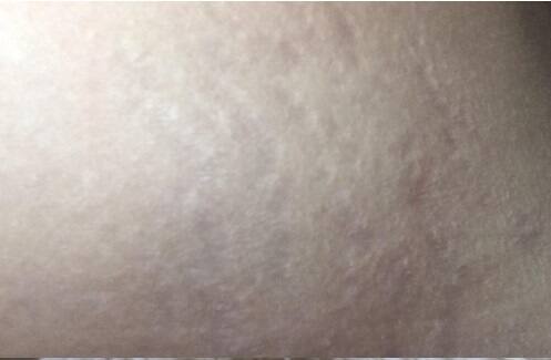 お腹の肉割れ(妊娠線)の画像|ケース2