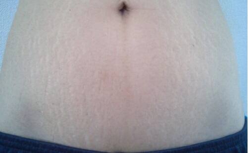 お腹の肉割れ(妊娠線)の画像|ケース3