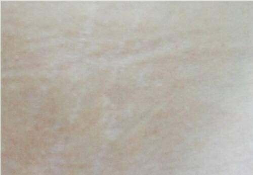 お腹の肉割れ(妊娠線)の画像|ケース4