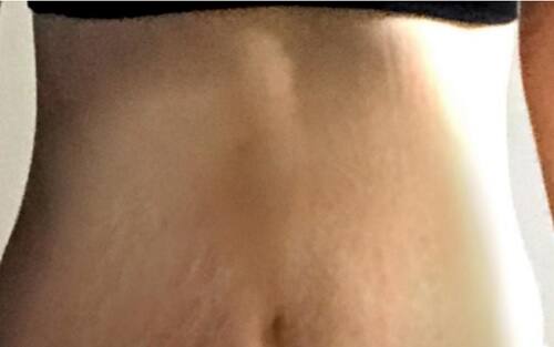 お腹の肉割れ(妊娠線)の画像|ケース5