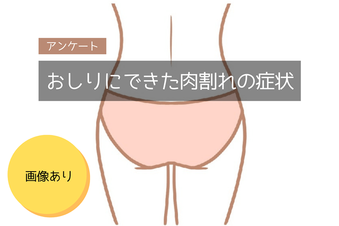 おしりにできた肉割れの症状を示したイラスト