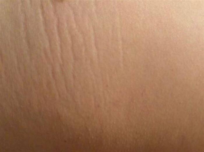 おしりにできた肉割れの症状を写した実際の体験画像