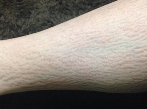 ふくらはぎにできた肉割れの症状