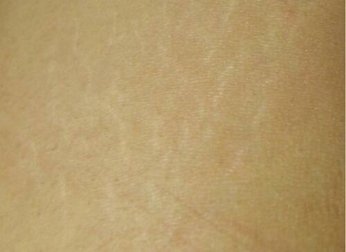 太もも内側にできた肉割れの症状