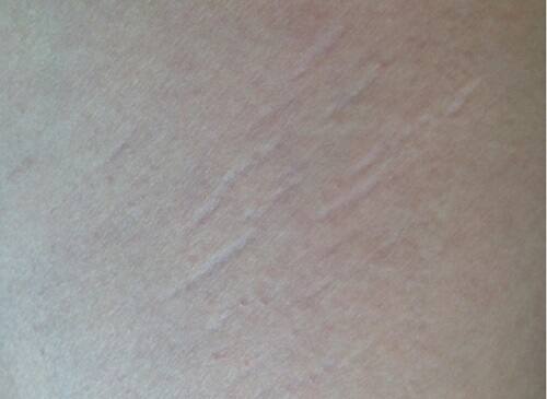 太ももの内側にできた肉割れ