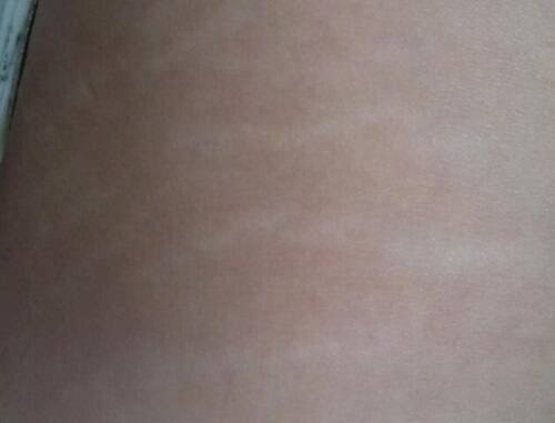 太もも外側にできた肉割れの症状