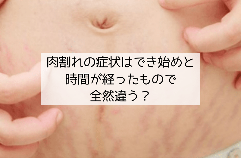 白い線状の肉割れが見える肌のアップ