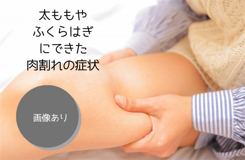 太ももやふくらはぎにできた肉割れの症状