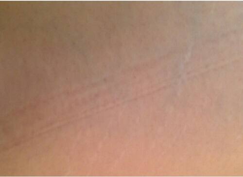 太ももにできた肉割れの症状